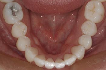 Invisalign After Lower