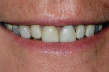 veneers before teeth cosmetic dentistry