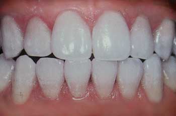 Teeth Bleaching After